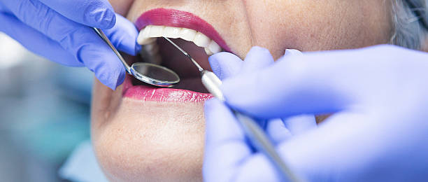Emergency Dental Filling Replacement in GA
